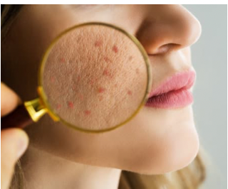 ACNE