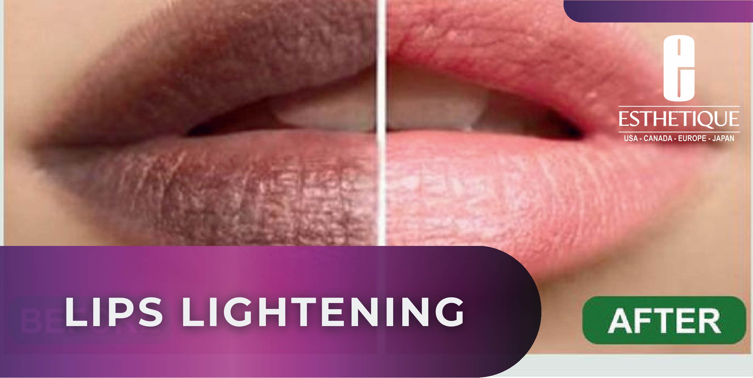 LIGHT LIPS